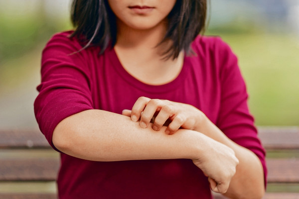 社工自我實驗抗濕疹 坊間治療方法 未必人人奏效