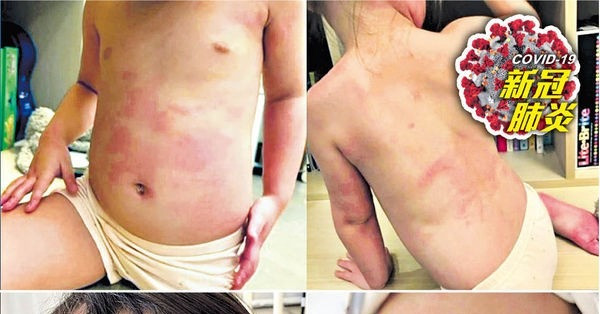 Omicron疑損神經中樞 14歲少年或因幻覺墮樓 染疫幼童康復後多重發炎