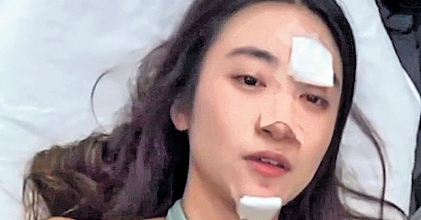 暈倒撼地變血面 黃紫恩手術留疤恐毀容