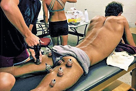 與子同游肌肉酸痛無力，應否學奧運選手做拔罐？