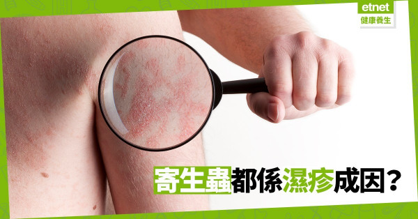 【另類治療】濕疹反反覆覆，共振儀器竟對寄生蟲起反應？