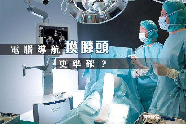 【膝蓋退化】重塑靈活關節？電腦導航「換骹」手術幫到你