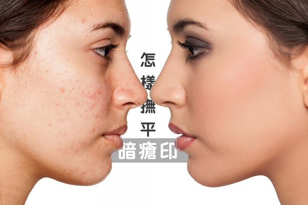 【青春的印記】重回無瑕肌膚！清除暗瘡疤痕有辦法