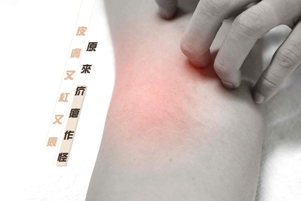 【傳染力驚人！】以為皮膚出紅疹？疥瘡常識要認知