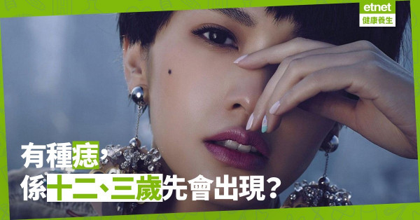 【痣的故事】十二、三歲才會出現的「顴痣」？