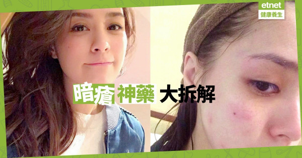 【痘痘肌救星】名人都愛用！口服維他命A酸很「毒」嗎？
