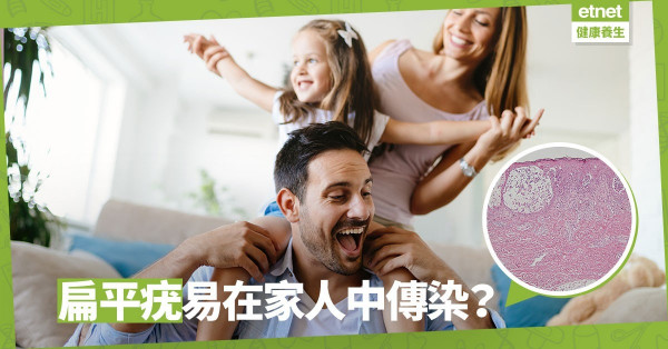【扁平疣】不知不覺傳播病毒！日常接觸易傳染俾屋企人？