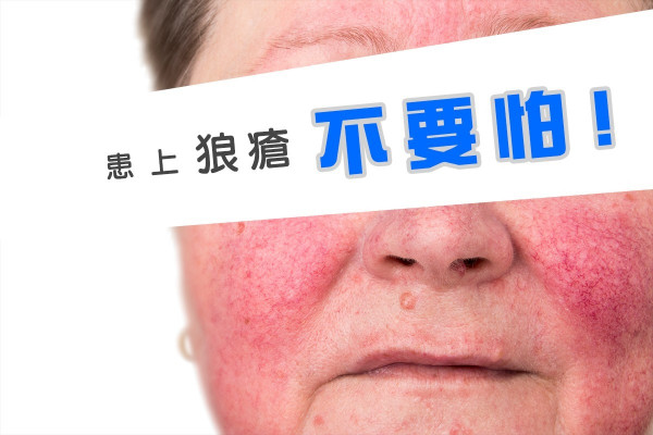 修煉氣功兩年，自癒紅斑狼瘡