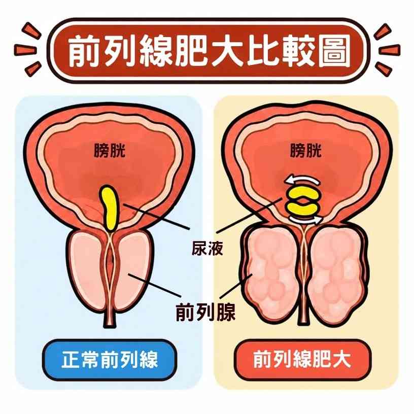 前列腺癌｜每24名港男1人患前列腺癌？！中秋聚會飲酒熬夜前列腺易受壓！拆解4大成因＋6大營養素急救＋月餅健康吃法