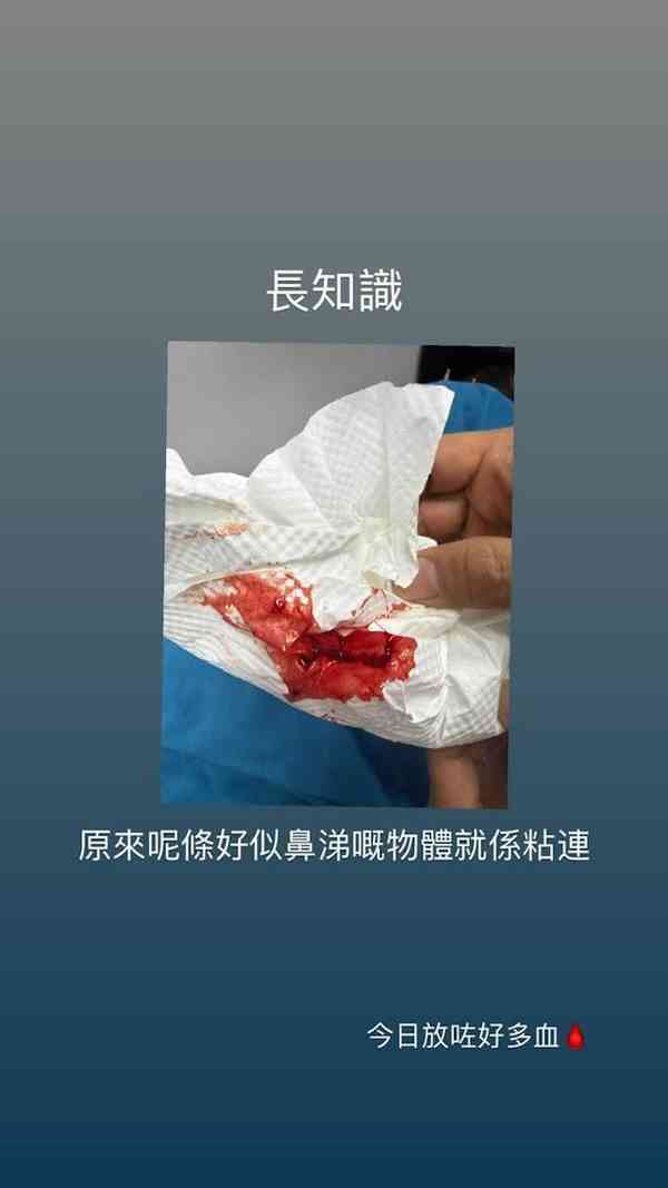 明星健康｜樂壇天后晒染血紙巾照　接受放血揭健康隱憂：慶祝我仲有生命