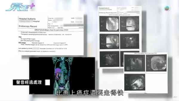 東張西望｜胰臟癌母手術流血不止身亡 家屬質疑醫療事故 絕密錄音曝醫生認失誤