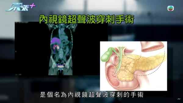 東張西望｜胰臟癌母手術流血不止身亡 家屬質疑醫療事故 絕密錄音曝醫生認失誤