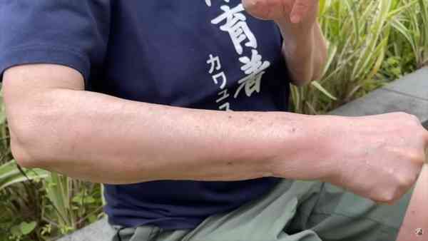 名人健康丨先後患乳癌及3期大腸癌　蘇施黃曝化療恐怖後遺症　2部位現駭人變化