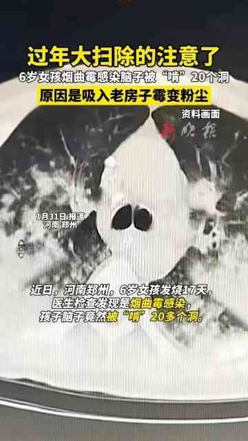 大掃除｜過年大掃除連續17天發高燒　「腦穿20個窿」險變植物人　醫揭吸入1種菌成致命元兇