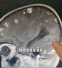 大掃除｜過年大掃除連續17天發高燒　「腦穿20個窿」險變植物人　醫揭吸入1種菌成致命元兇