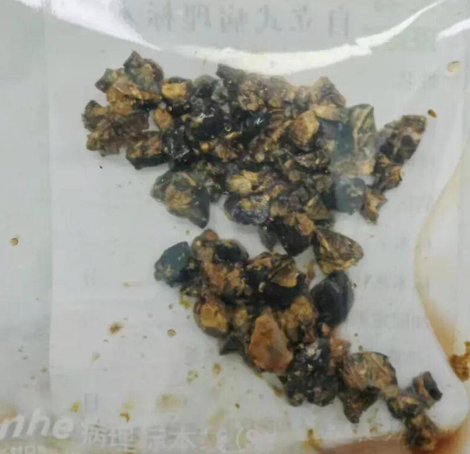 膽結石｜35歲OL突腹痛送院 膽囊塞爆60粒膽石極可怕 揭長期做錯1件事惹禍