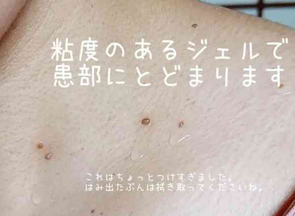 脫疣神器｜Threads爆紅$68「脫疣神器」　毋須做Laser無痛去疣　網民激讚：搽咗幾次成粒甩咗！