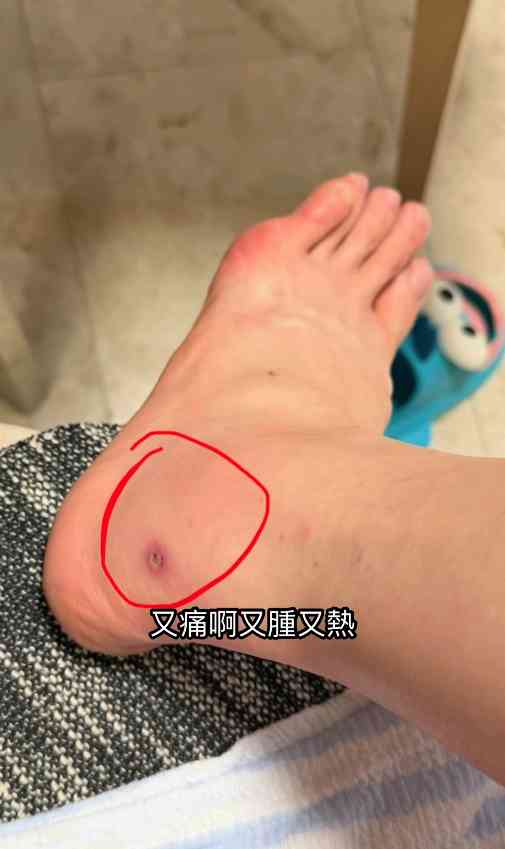 細菌感染︱港女腳眼被蚊咬「小蚊爛」變蜂窩性組織炎　急速惡化腫如網球