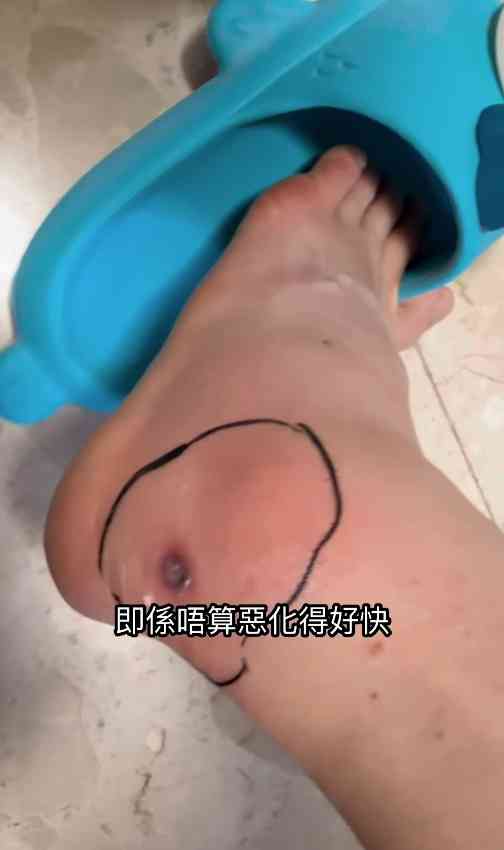 細菌感染︱港女腳眼被蚊咬「小蚊爛」變蜂窩性組織炎　急速惡化腫如網球