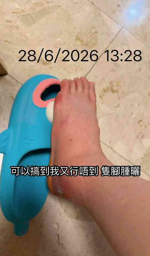 細菌感染︱港女腳眼被蚊咬「小蚊爛」變蜂窩性組織炎　急速惡化腫如網球