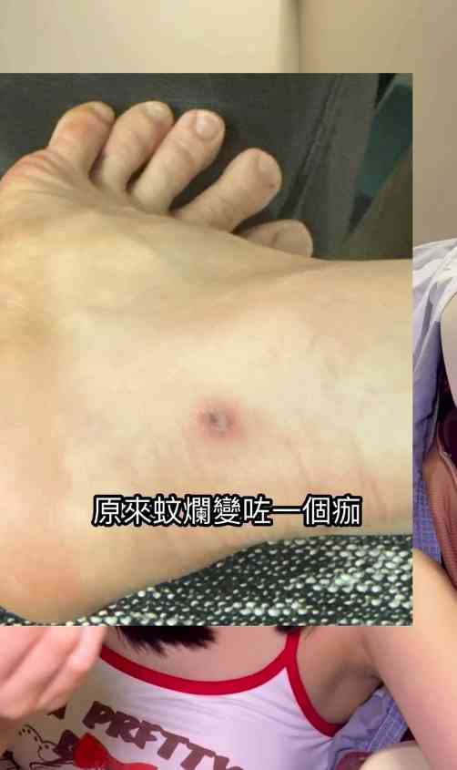 細菌感染︱港女腳眼被蚊咬「小蚊爛」變蜂窩性組織炎　急速惡化腫如網球