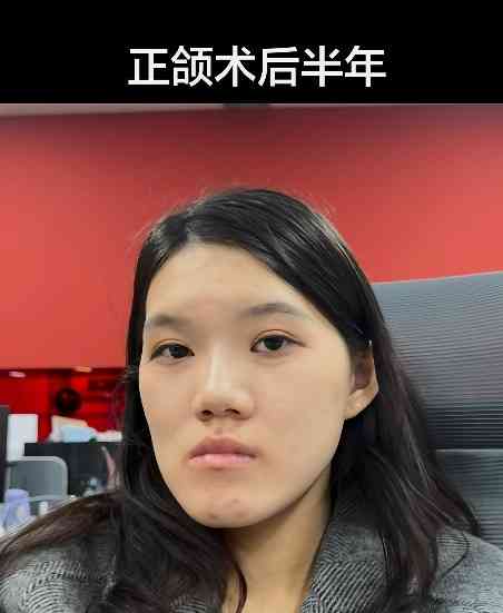 正顎手術丨24歲女做正顎手術反變「鞋抽面」 　醫生死撐：我喜歡這種臉型