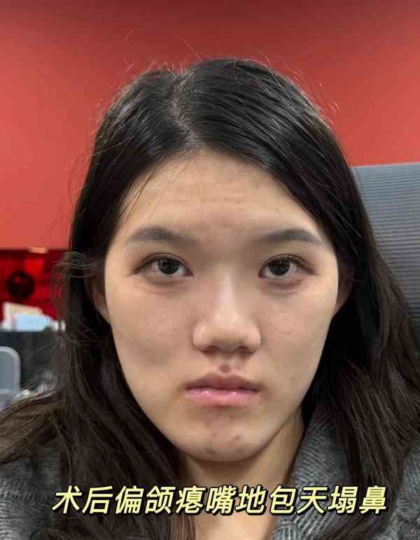 正顎手術丨24歲女做正顎手術反變「鞋抽面」 　醫生死撐：我喜歡這種臉型