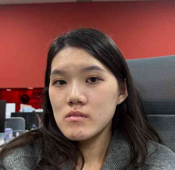 正顎手術丨24歲女做正顎手術反變「鞋抽面」 　醫生死撐：我喜歡這種臉型