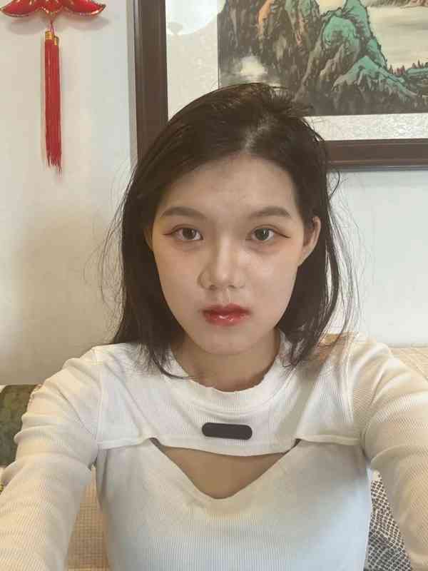 正顎手術丨24歲女做正顎手術反變「鞋抽面」 　醫生死撐：我喜歡這種臉型