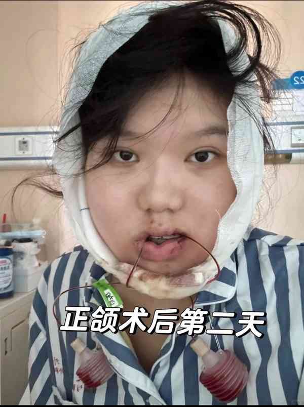 正顎手術丨24歲女做正顎手術反變「鞋抽面」 　醫生死撐：我喜歡這種臉型