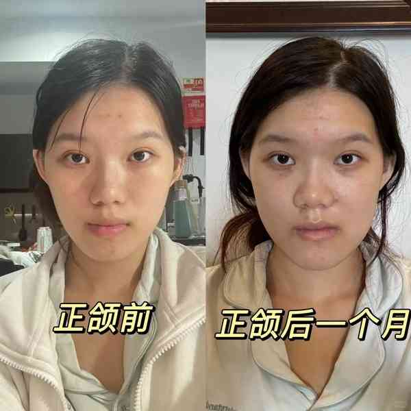 正顎手術丨24歲女做正顎手術反變「鞋抽面」 　醫生死撐：我喜歡這種臉型