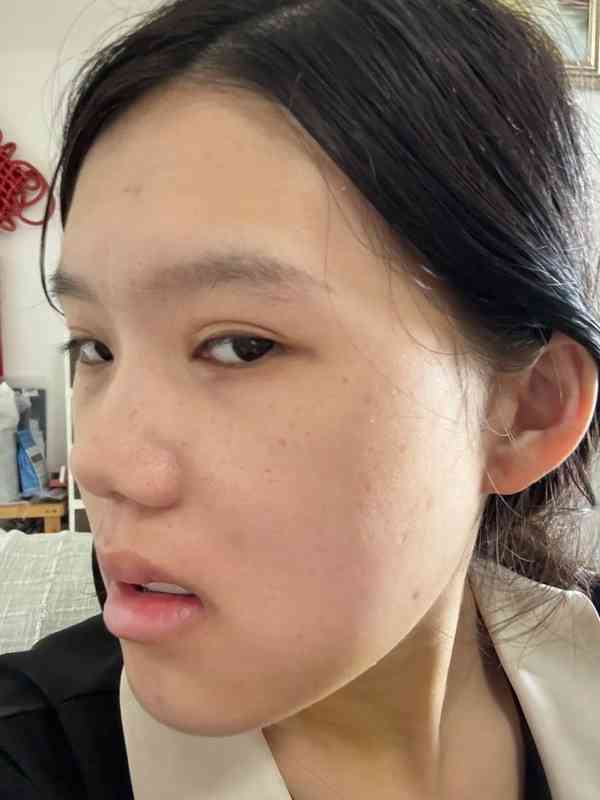 正顎手術丨24歲女做正顎手術反變「鞋抽面」 　醫生死撐：我喜歡這種臉型