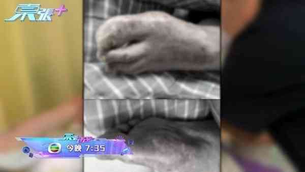 張偉文｜「靚聲王」張偉文疑遭護老院疏忽照顧　傷口潰爛見骨一年半冇沖涼床上痛哭　經理人偕《東張》團隊上門對質