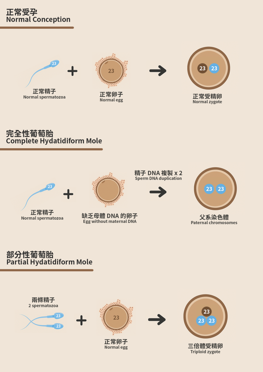 葡萄胎還可以生育嗎？懷孕初期異常出血要警惕