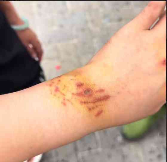 鯊魚襲擊︱26歲女網紅生理期潛水追趕鯊魚遭咬傷　炫耀傷痕拒就醫：截肢是從這邊嗎？