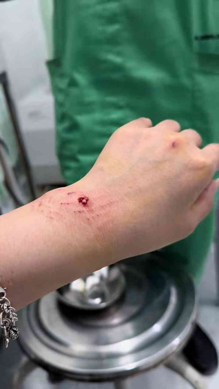 鯊魚襲擊︱26歲女網紅生理期潛水追趕鯊魚遭咬傷　炫耀傷痕拒就醫：截肢是從這邊嗎？