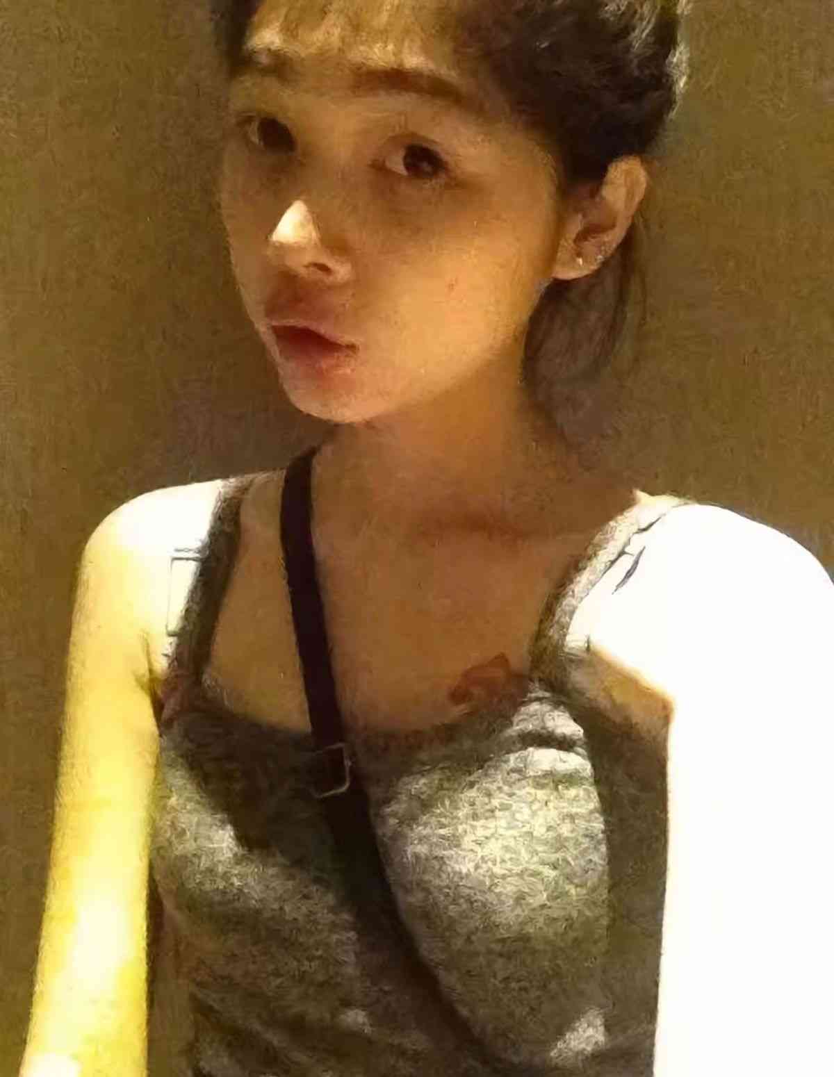 網絡熱話｜27歲女患厭食症體重僅得38磅半　極悲慘身世曝光：我想活下去
