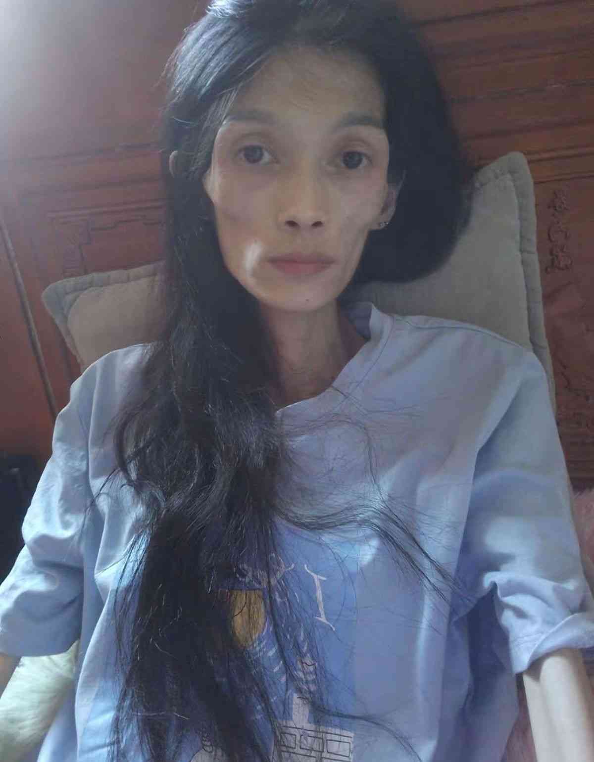 網絡熱話｜27歲女患厭食症體重僅得38磅半　極悲慘身世曝光：我想活下去