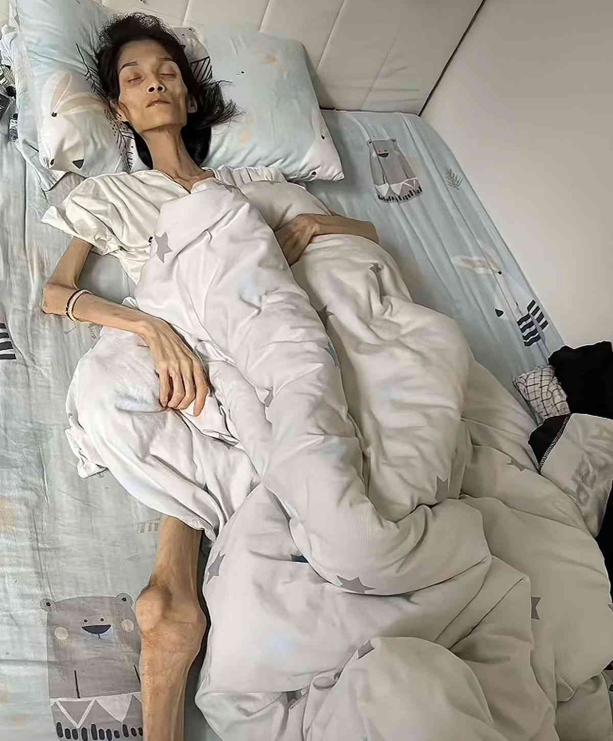 網絡熱話｜27歲女患厭食症體重僅得38磅半　極悲慘身世曝光：我想活下去