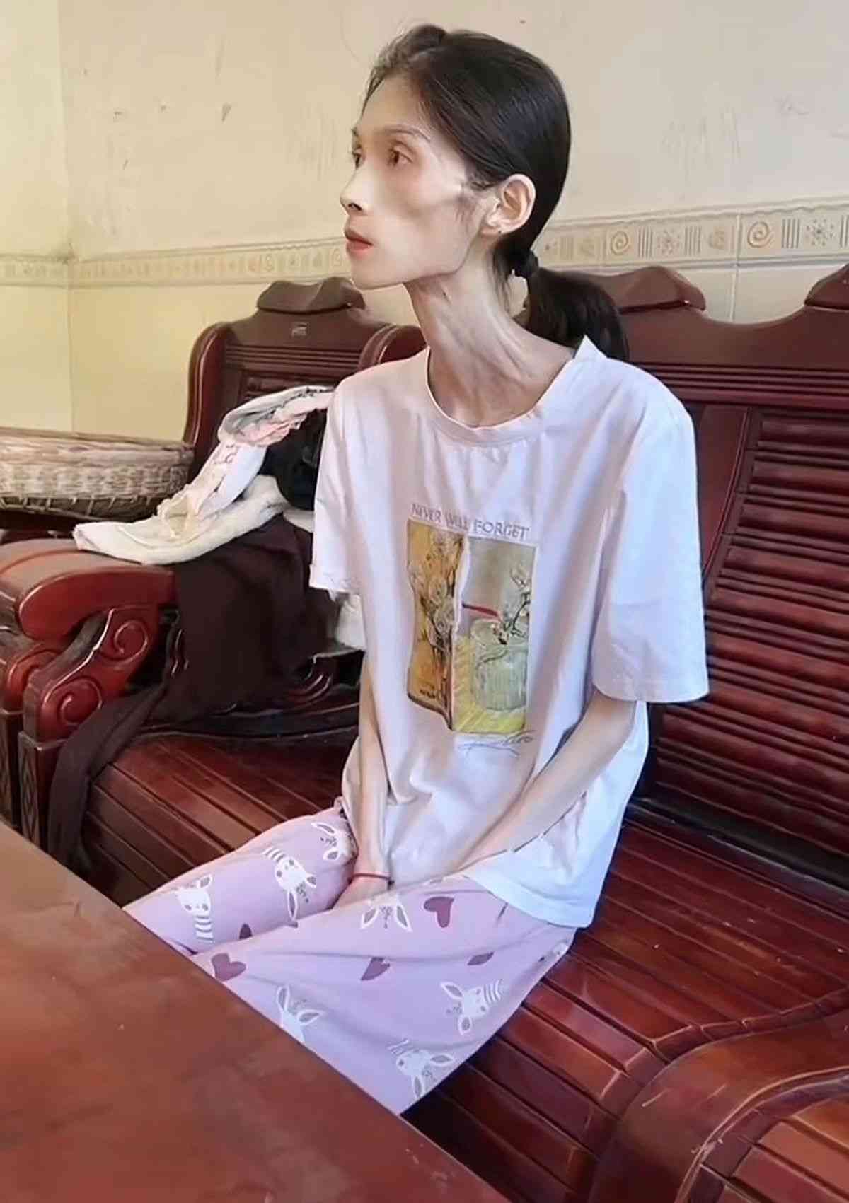 網絡熱話｜27歲女患厭食症體重僅得38磅半　極悲慘身世曝光：我想活下去