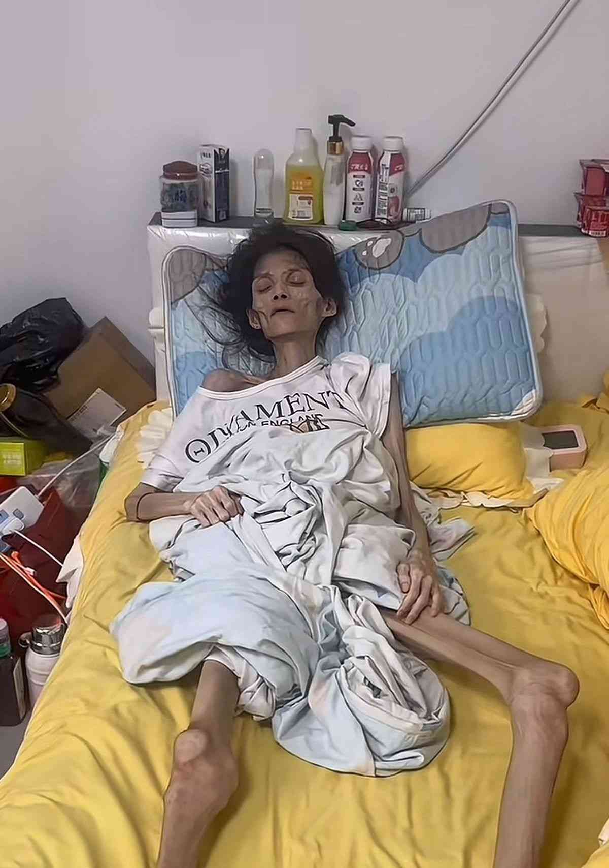 網絡熱話｜27歲女患厭食症體重僅得38磅半　極悲慘身世曝光：我想活下去