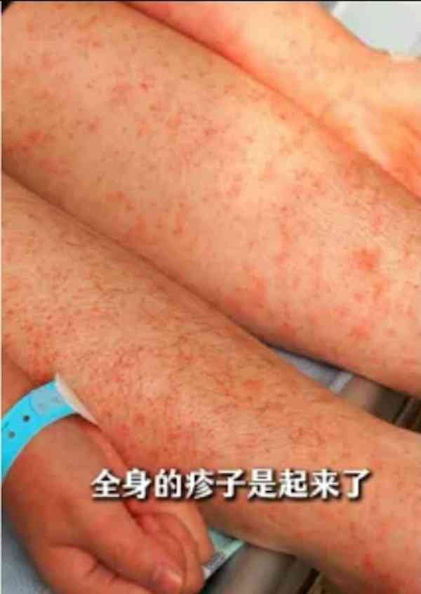基孔肯雅熱丨基孔肯雅熱本港現首宗輸入個案 佛山曝光患者相 全身出疹、發高燒、關節劇痛或引嚴重併發症