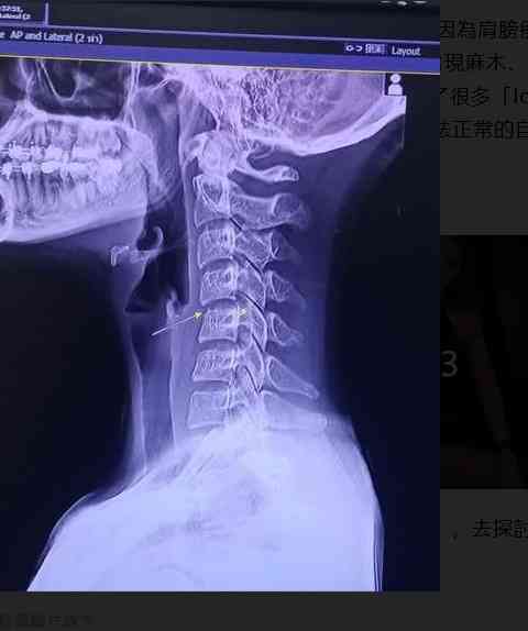 健康新聞報道丨20歲女星泰式按摩lock頸身亡　TVB節目「驗屍」探真相醫生：1個位置絕不能按