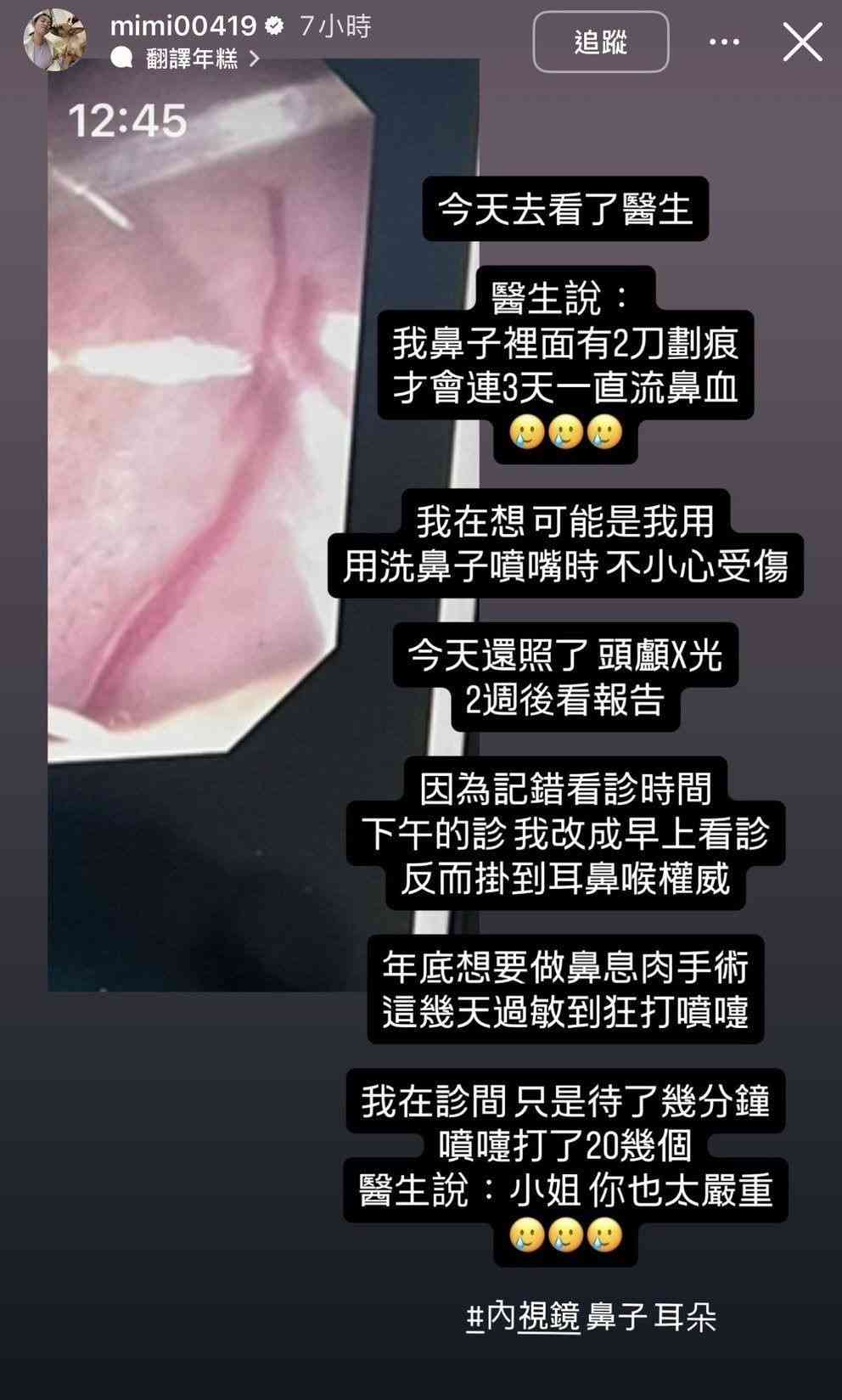 明星健康｜39歲女星連續3日狂流鼻血　鼻腔驚現刀痕需動手術　疑用1物不慎肇禍