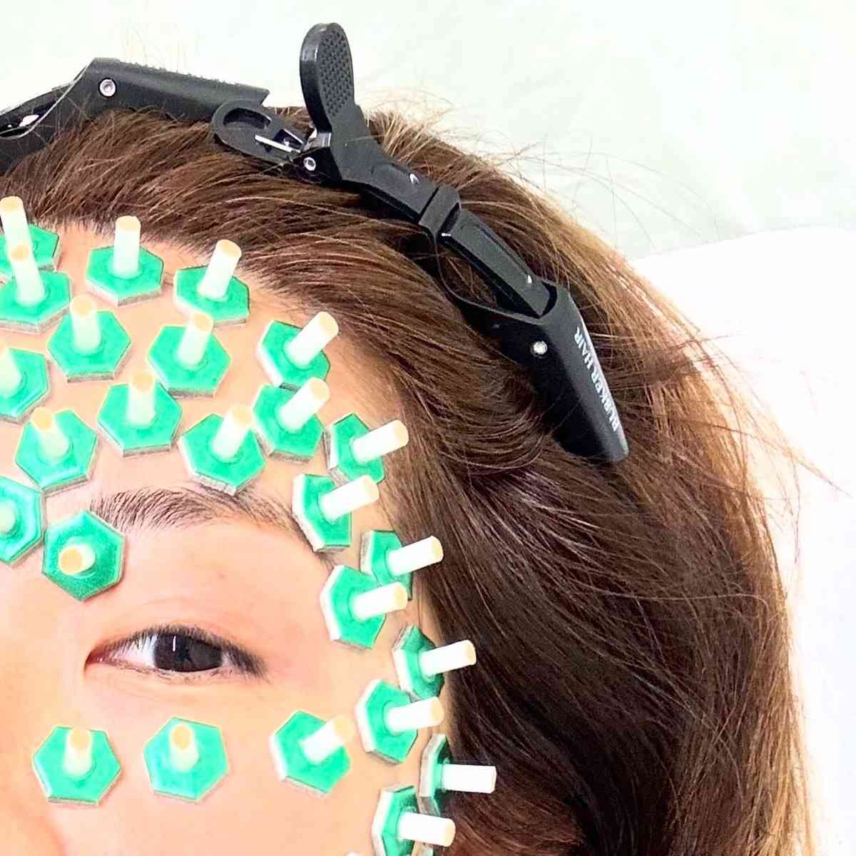拔罐驚魂｜前商台DJ麻利因1事全身濕疹　飛東京連拔4日罐致貧血　虛脫返港險暈倒機場