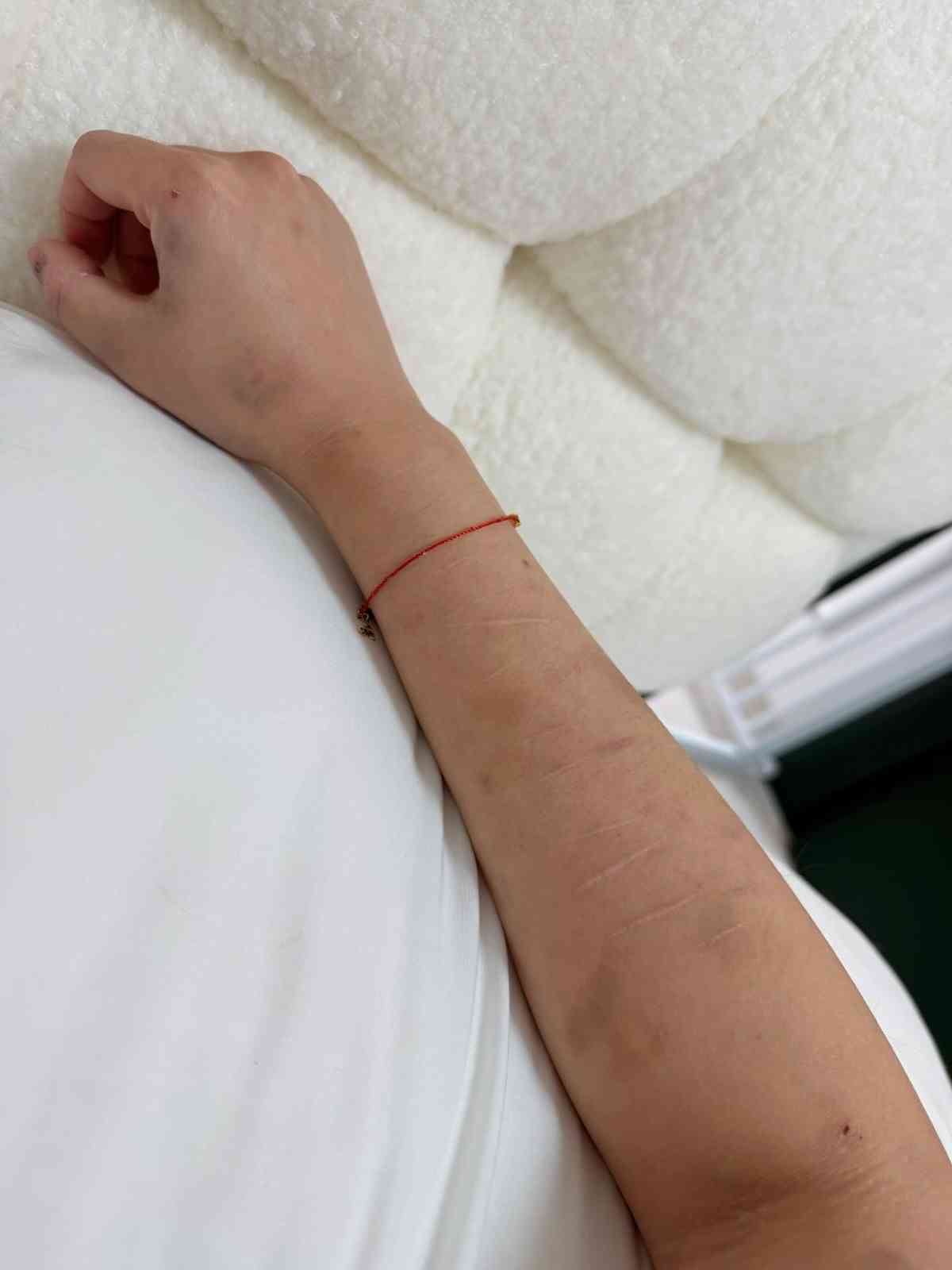 外遊注意｜美女網紅首爾拒搭訕慘遭2陌生男暴打　全身瘀傷兼拇指骨折　韓警處理手法惹熱議