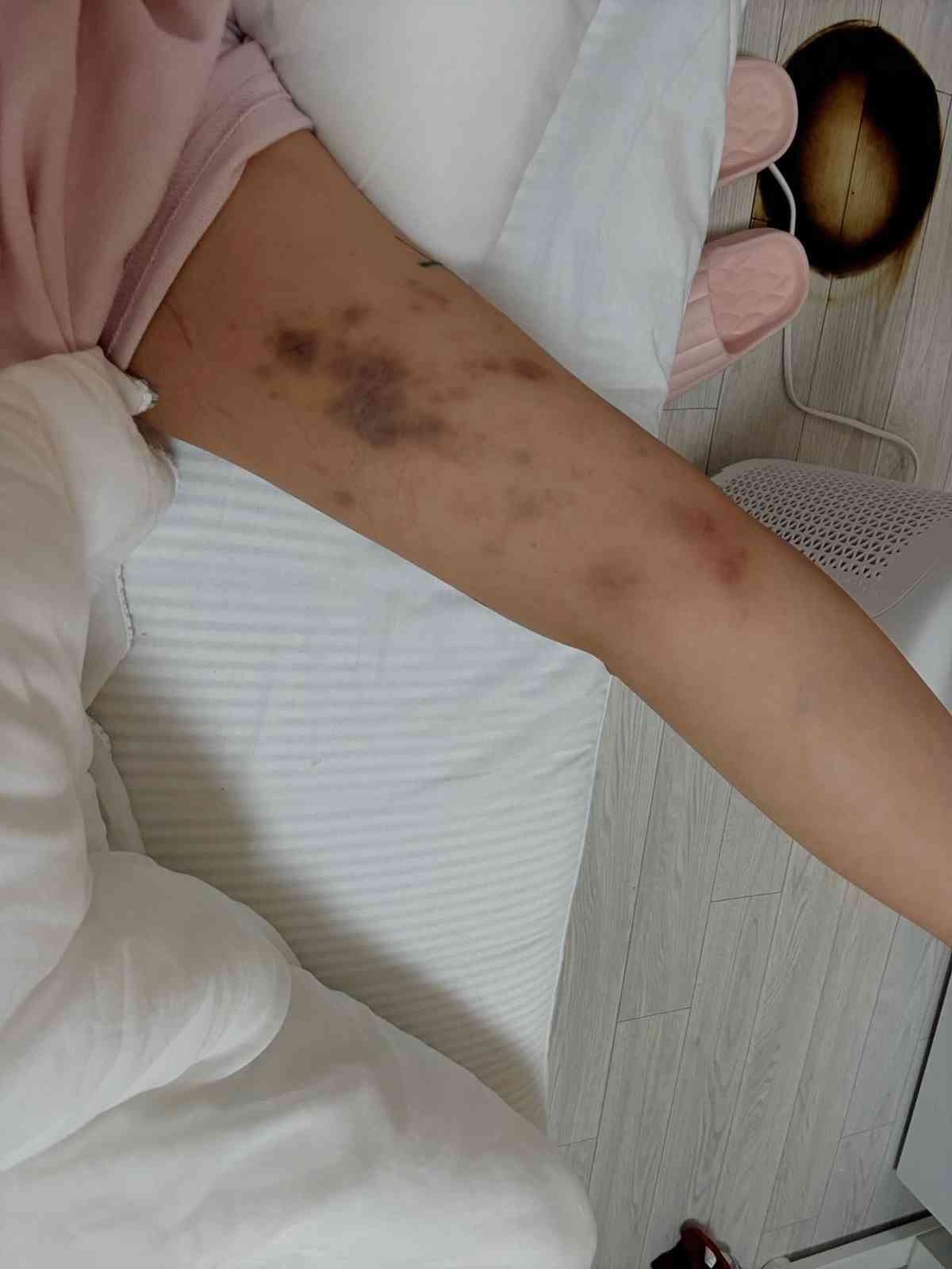 外遊注意｜美女網紅首爾拒搭訕慘遭2陌生男暴打　全身瘀傷兼拇指骨折　韓警處理手法惹熱議