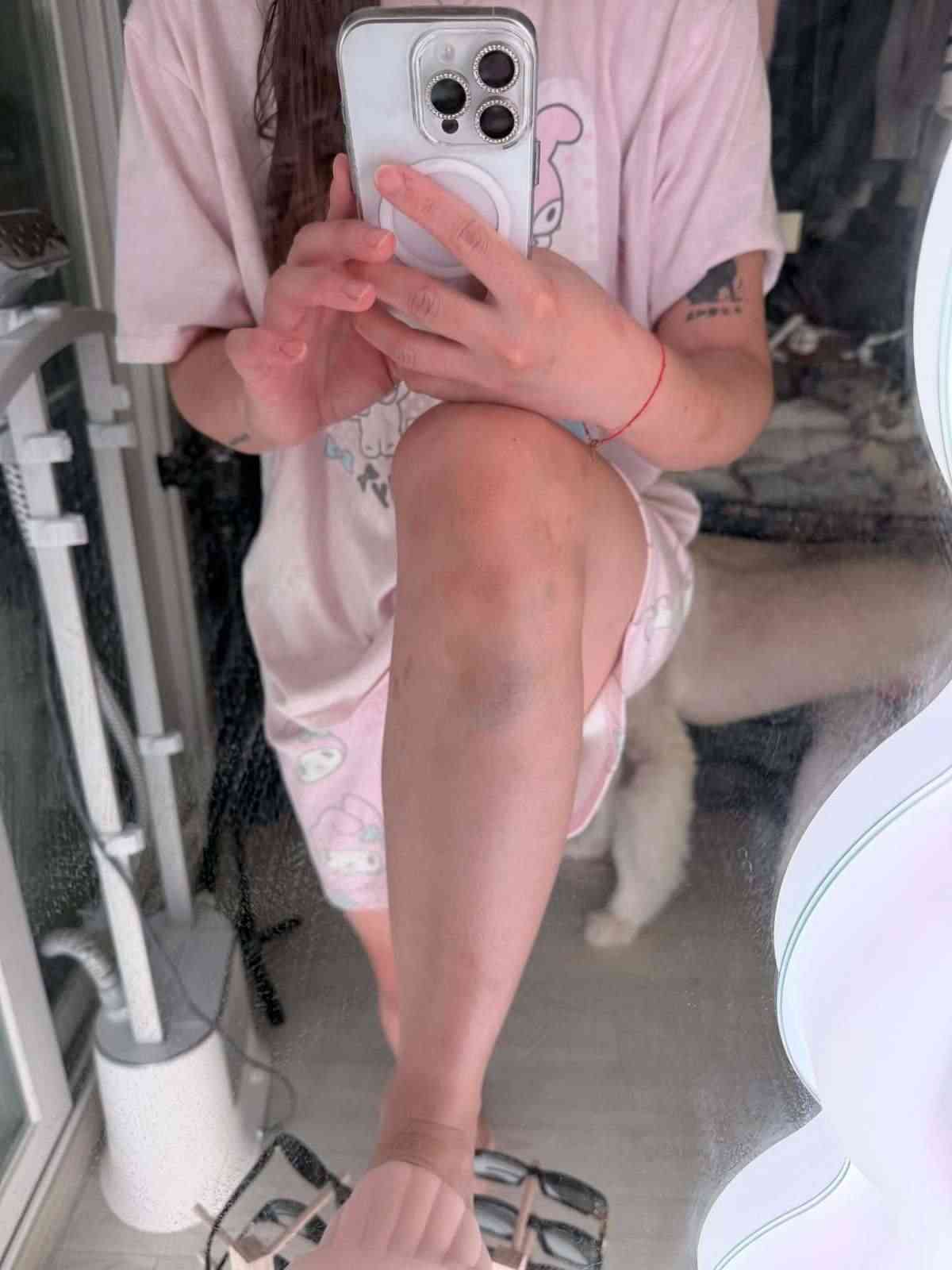 外遊注意｜美女網紅首爾拒搭訕慘遭2陌生男暴打　全身瘀傷兼拇指骨折　韓警處理手法惹熱議