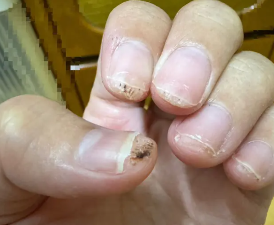 Gel甲惹禍｜女子Gel甲被割傷手指　10指全染「椰菜花」　醫生震驚：第一次見到