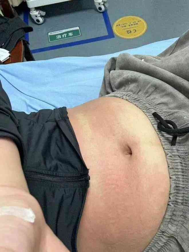 蕁麻疹丨女子食蝦後健身竟致「嚴重過敏」險死　醫警告：6小時內勿做1件事　恐窒息致命